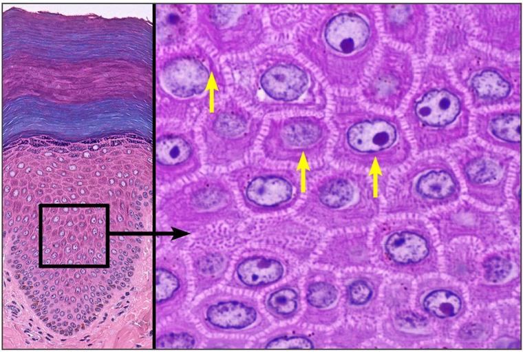 Epidermis with a boxed area enlarged to show polygonal cells joined by spiny bridges, with yellow arrows