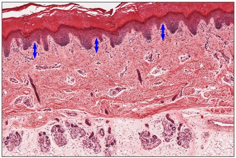 Skin section with blue arrows marking the thin loose layer of dermis just under the epidermis