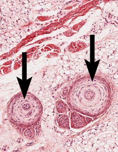 Two large onion-like corpuscles in the deep dermis, each marked by a black arrow