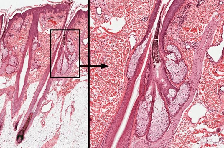 Section of hairy skin with a boxed sebaceous gland beside a follicle, enlarged to show clusters of large pale cells