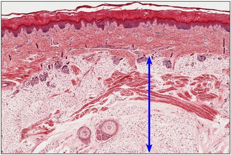 Low-power section of skin with a long blue arrow spanning the deep fatty layer beneath the dermis