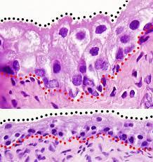 Transitional epithelium of the bladder comparing relaxed and distended states
