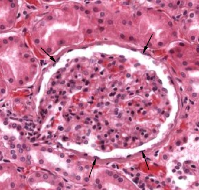 Simple squamous epithelium lining Bowman's capsule around a renal glomerulus